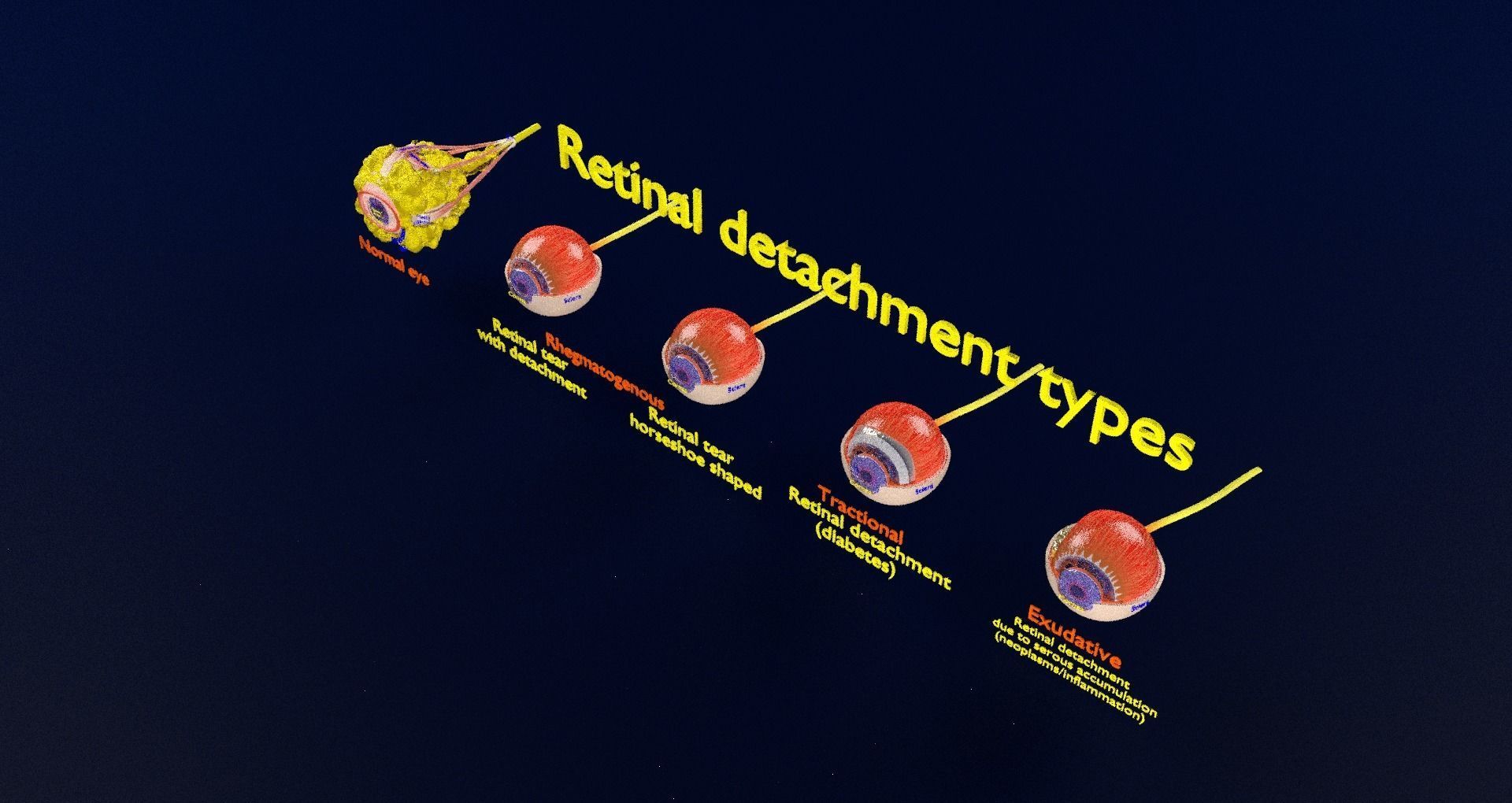 Retinal detachment types eye 3D model - Blender Market