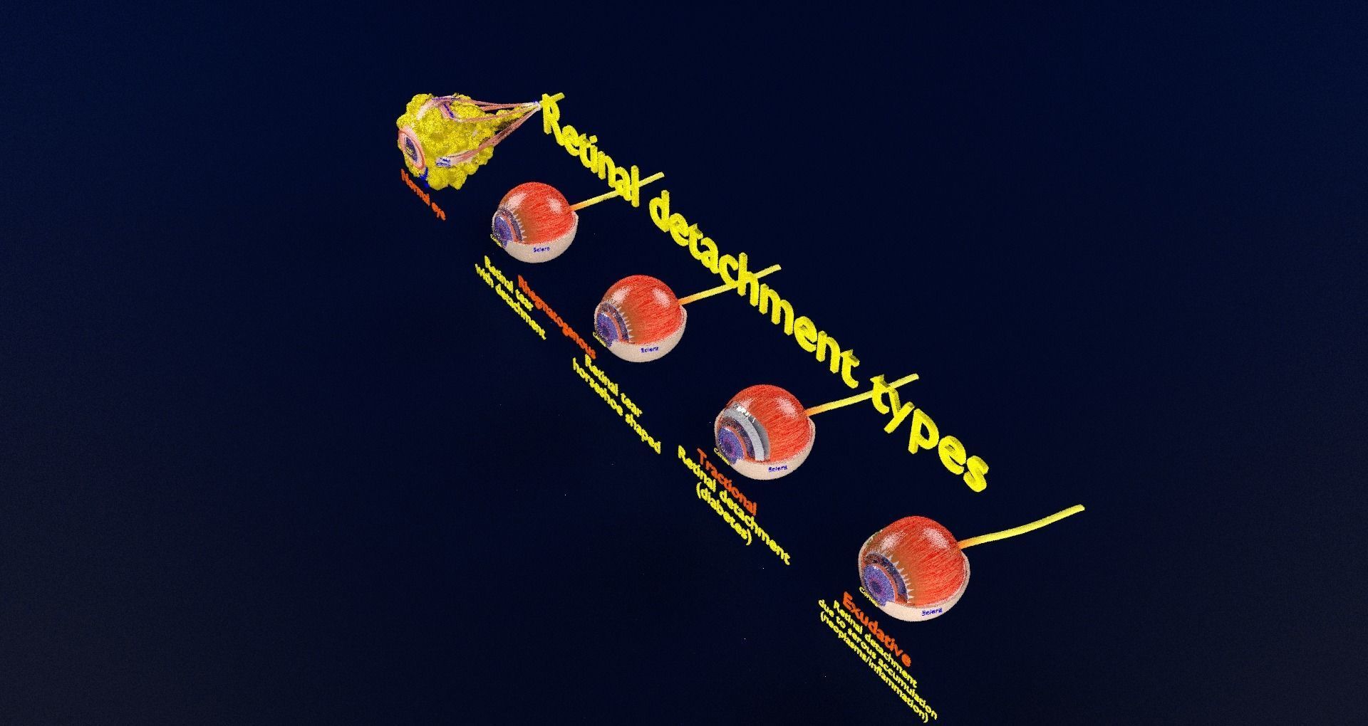 Retinal detachment types eye 3D model - Blender Market